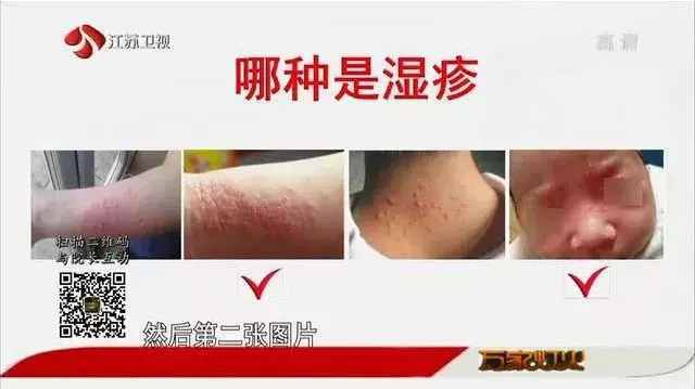痱子濕疹傻傻分不清？最全濕疹指南，教你辨清癥狀，遠離瘙癢~