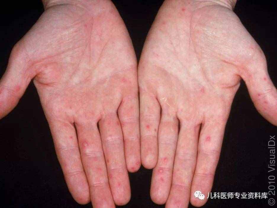 手足口病終結版——讓你明明白白知道是什么、為什么、怎么辦！