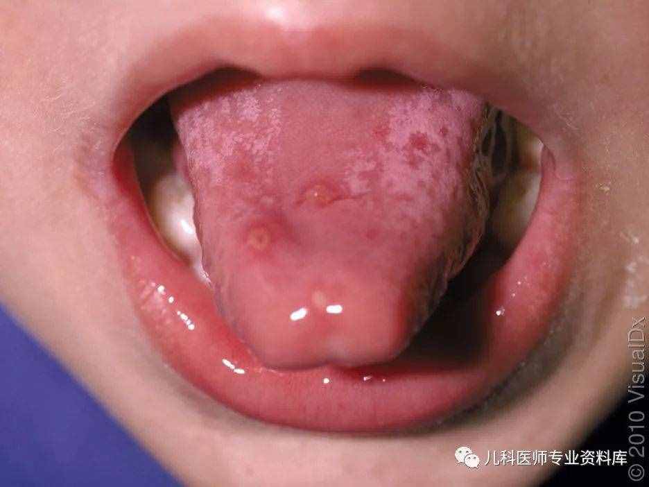 手足口病終結版——讓你明明白白知道是什么、為什么、怎么辦！