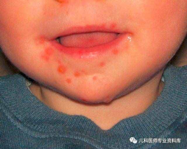 手足口病終結版——讓你明明白白知道是什么、為什么、怎么辦！