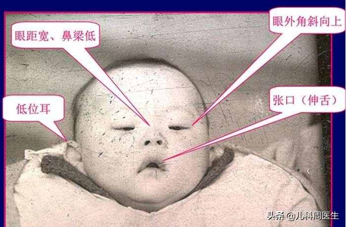 誰(shuí)家愿意出生“唐氏兒”，唐氏篩查事關(guān)２１三體綜合癥的風(fēng)險(xiǎn)評(píng)估