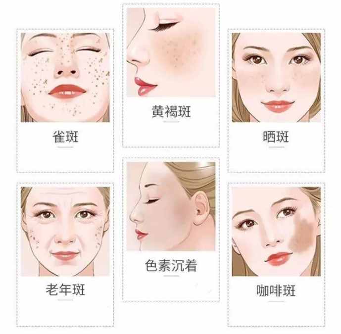 臉上的斑，有什么方法去除？別踩雷了，真正有效祛斑的方法都在這