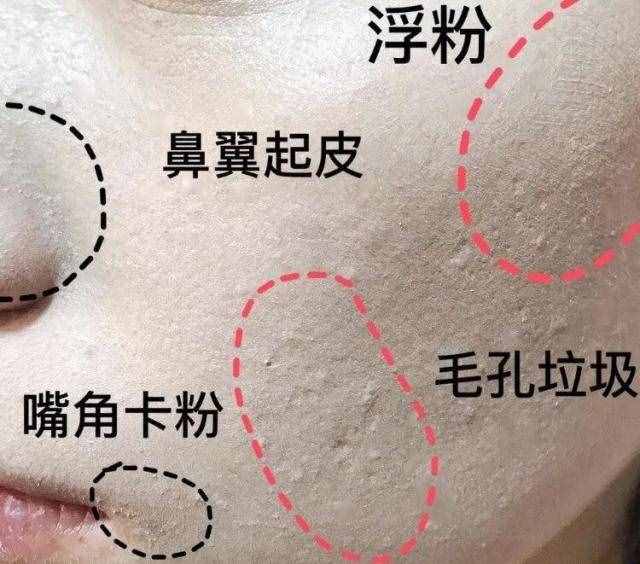什么是閉口粉刺？為什么會(huì)長(zhǎng)閉口？如何有效去閉口