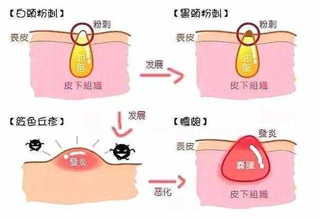 什么是閉口粉刺？為什么會(huì)長(zhǎng)閉口？如何有效去閉口