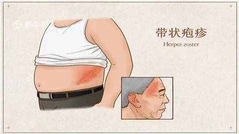 什么是帶狀皰疹？用什么藥治療？