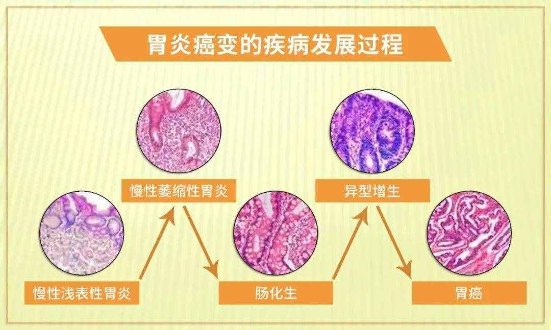 胃病都有哪些，什么癥狀