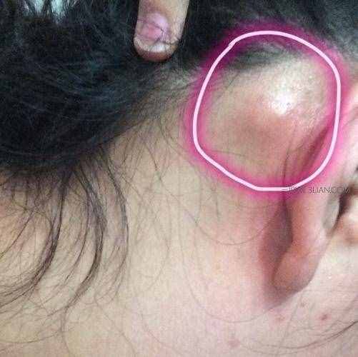 耳朵后面長了個(gè)疙瘩是怎么回事？醫(yī)生說：要小心這幾種情況！