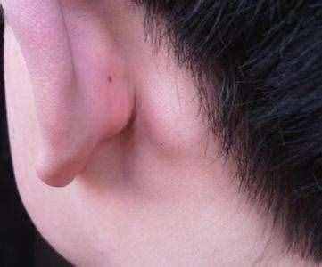 耳朵后面長了個(gè)疙瘩是怎么回事？醫(yī)生說：要小心這幾種情況！