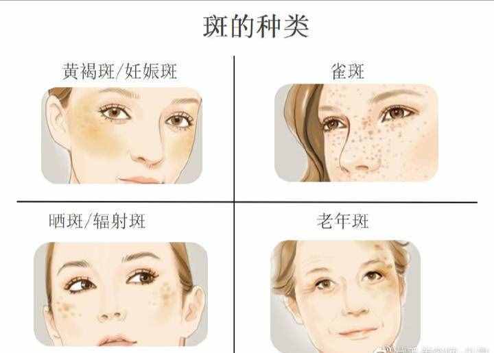 肌膚長斑怎么辦？如何預(yù)防斑點和淡斑？
