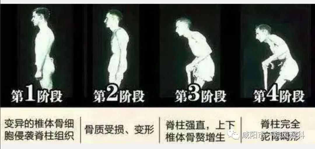 咸陽市第一人民醫(yī)院："不死的癌癥"——強直性脊柱炎20年抗爭記