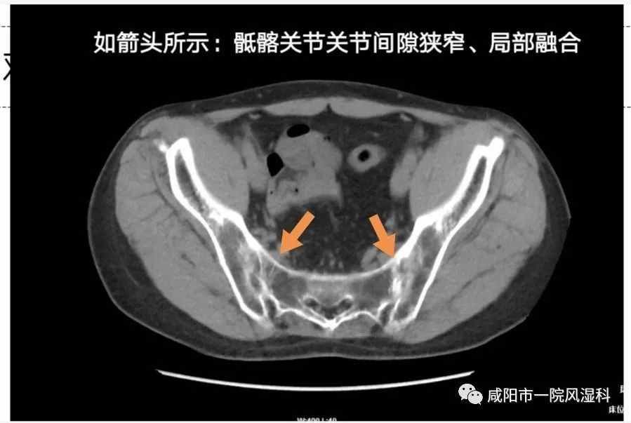 咸陽市第一人民醫(yī)院："不死的癌癥"——強直性脊柱炎20年抗爭記