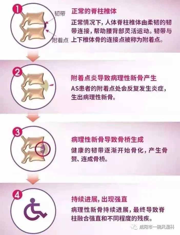 咸陽市第一人民醫(yī)院："不死的癌癥"——強直性脊柱炎20年抗爭記