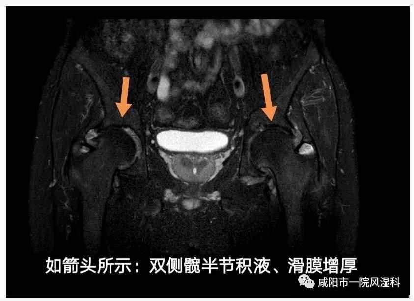 咸陽市第一人民醫(yī)院："不死的癌癥"——強直性脊柱炎20年抗爭記