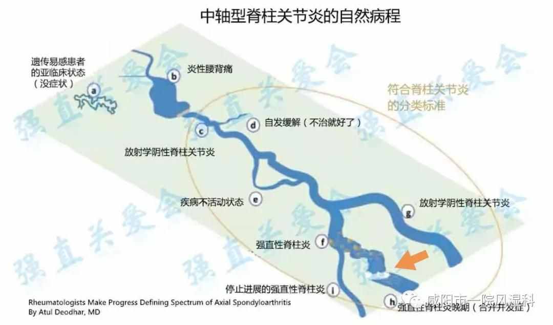 咸陽市第一人民醫(yī)院："不死的癌癥"——強直性脊柱炎20年抗爭記