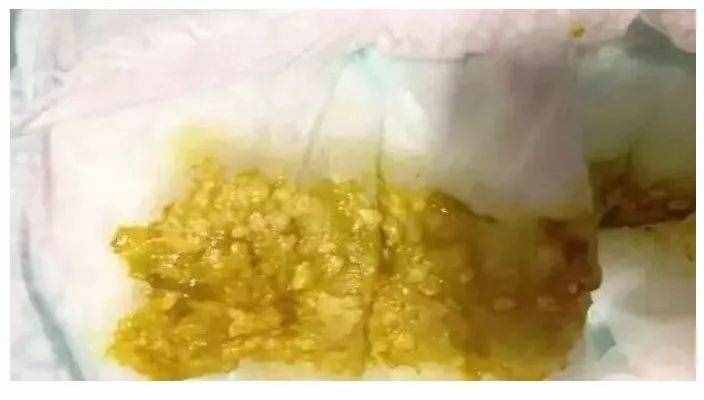 新嬰兒大便對照表！快來對照一下你家寶寶的大便是否正常！
