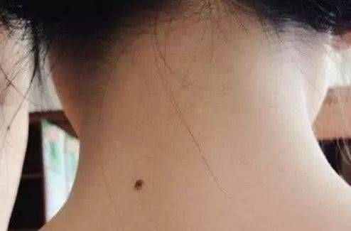 為什么很多人脖子后面會(huì)長(zhǎng)一顆黑痣？是在暗示什么？別過(guò)于相信