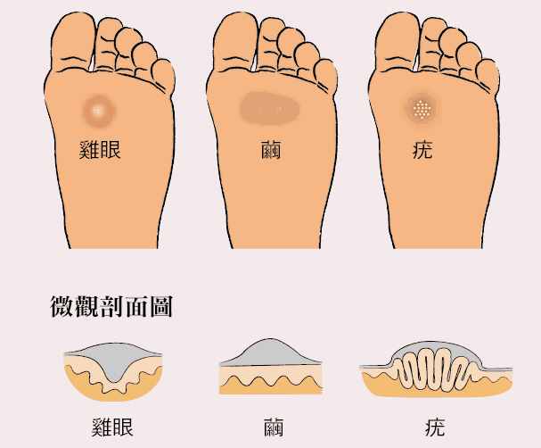 痛痛痛！腳底長了雞眼怎么辦，挖掉會再長嗎？醫(yī)生告訴你怎么做