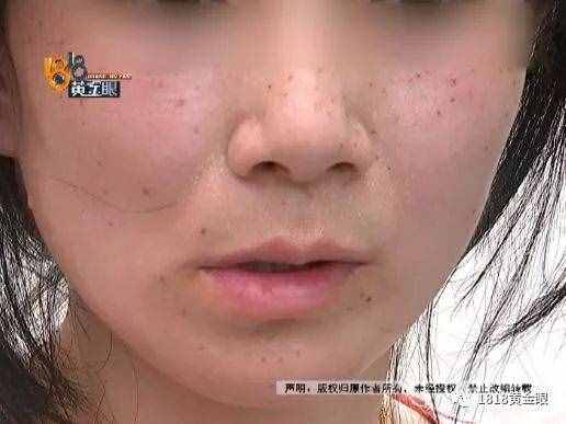 女子去點(diǎn)痣，一顆痣80元，點(diǎn)了110顆！老公怒了，結(jié)果……