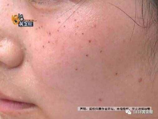 女子去點(diǎn)痣，一顆痣80元，點(diǎn)了110顆！老公怒了，結(jié)果……