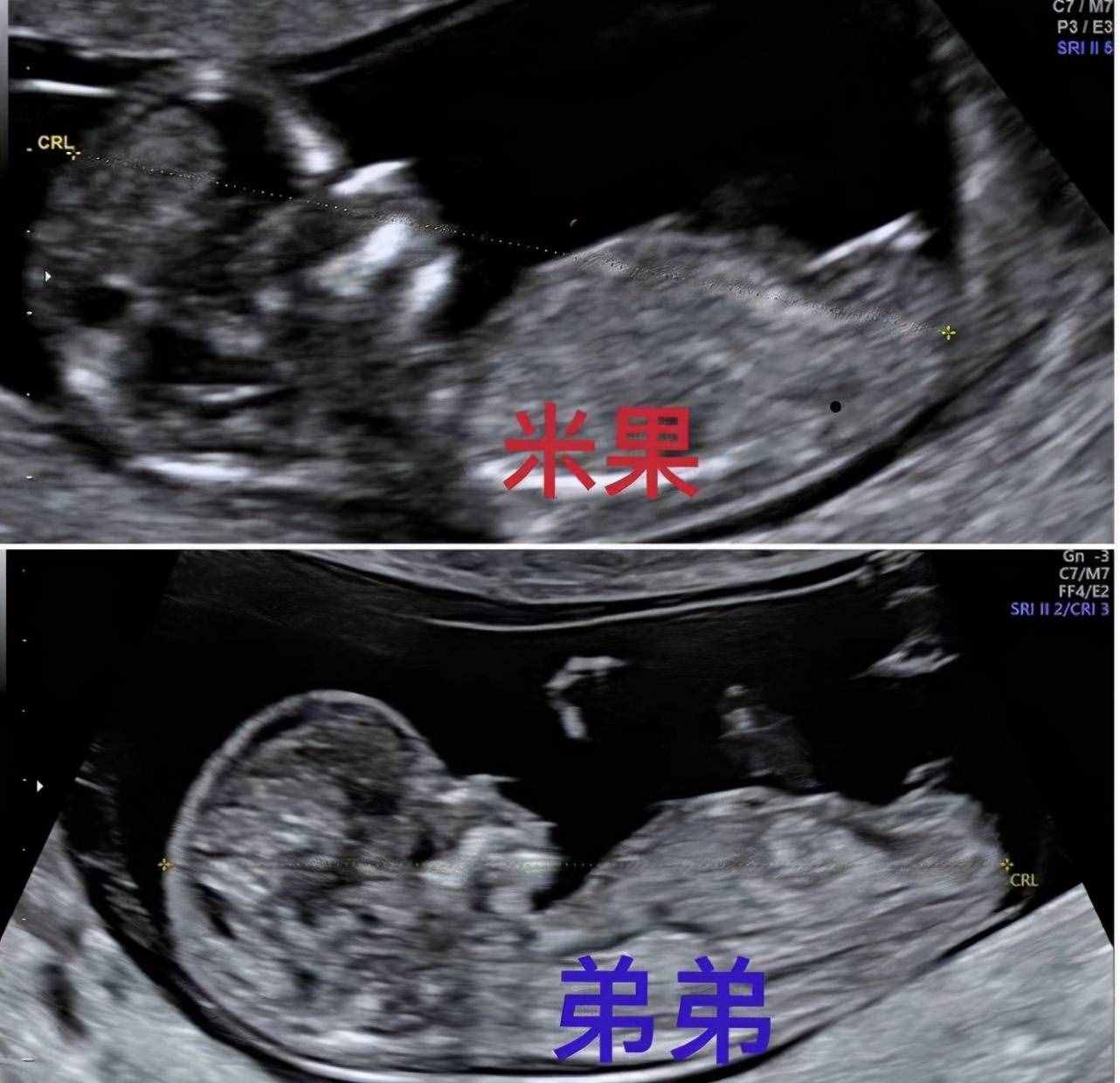 羅志祥43歲經(jīng)紀人小霜宣布懷二胎，仍是試管嬰兒，孩子父親不詳