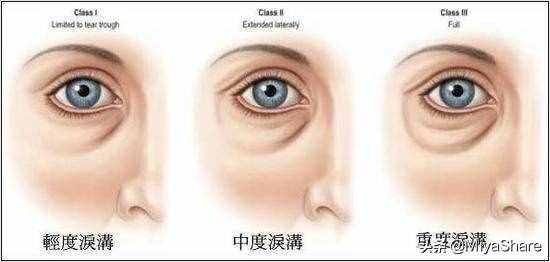 醒醒吧：什么眼霜都救不了黑眼圈！6款眼霜分析：這2款又貴又沒用