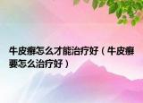 牛皮癬怎么才能治療好（牛皮癬要怎么治療好）