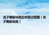 光子嫩膚祛斑后恢復(fù)過程圖（光子嫩膚祛斑）