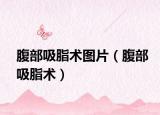 腹部吸脂術圖片（腹部吸脂術）