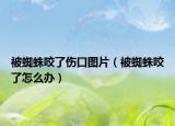 被蜘蛛咬了傷口圖片（被蜘蛛咬了怎么辦）