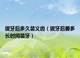 拔牙后多久裝義齒（拔牙后要多長(zhǎng)時(shí)間裝牙）