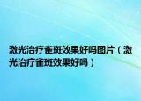 激光治療雀斑效果好嗎圖片（激光治療雀斑效果好嗎）