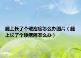 腿上長(zhǎng)了個(gè)硬疙瘩怎么辦圖片（腿上長(zhǎng)了個(gè)硬疙瘩怎么辦）