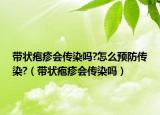 帶狀皰疹會(huì)傳染嗎?怎么預(yù)防傳染?（帶狀皰疹會(huì)傳染嗎）
