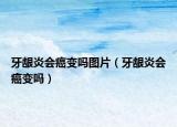 牙齦炎會癌變嗎圖片（牙齦炎會癌變嗎）