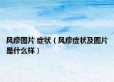 風(fēng)疹圖片 癥狀（風(fēng)疹癥狀及圖片是什么樣）