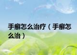 手癬怎么治療（手癬怎么治）