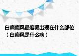 白癩癜風最容易出現(xiàn)在什么部位（白癜風是什么?。? /></span></a>
                        <h2><a href=