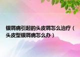 銀屑病引起的頭皮屑怎么治療（頭皮型銀屑病怎么辦）