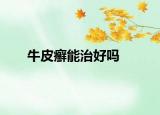 牛皮癬能治好嗎