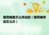 銀屑病是怎么傳染的（銀屑病傳染怎么辦）