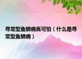 尋常型魚鱗病真可怕（什么是尋常型魚鱗?。? /></span></a>
                        <h2><a href=
