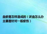 血瘀是怎樣造成的（淤血怎么辦 主要是針對一般瘀傷）