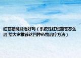 紅蒼狼斑能治好嗎（系統(tǒng)性紅斑狼蒼怎么治 給大家推薦這四種藥物治療方法）