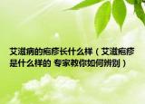 艾滋病的皰疹長(zhǎng)什么樣（艾滋皰疹是什么樣的 專(zhuān)家教你如何辨別）