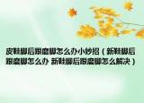 皮鞋腳后跟磨腳怎么辦小妙招（新鞋腳后跟磨腳怎么辦 新鞋腳后跟磨腳怎么解決）